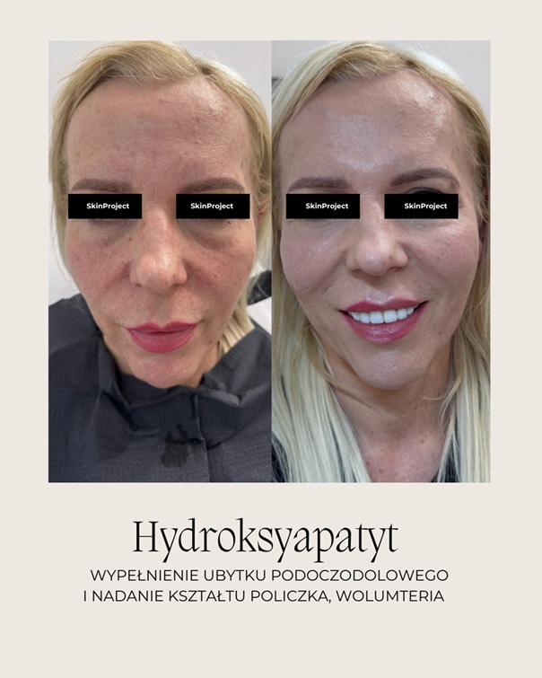Hydroksyapatyt wapnia przed i po 4