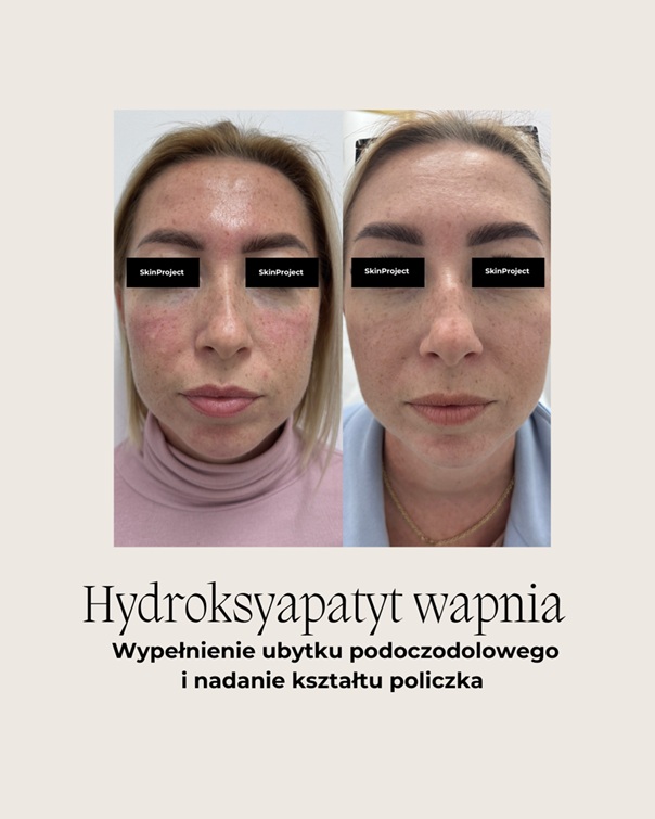 Hydroksyapatyt wapnia przed i po 5