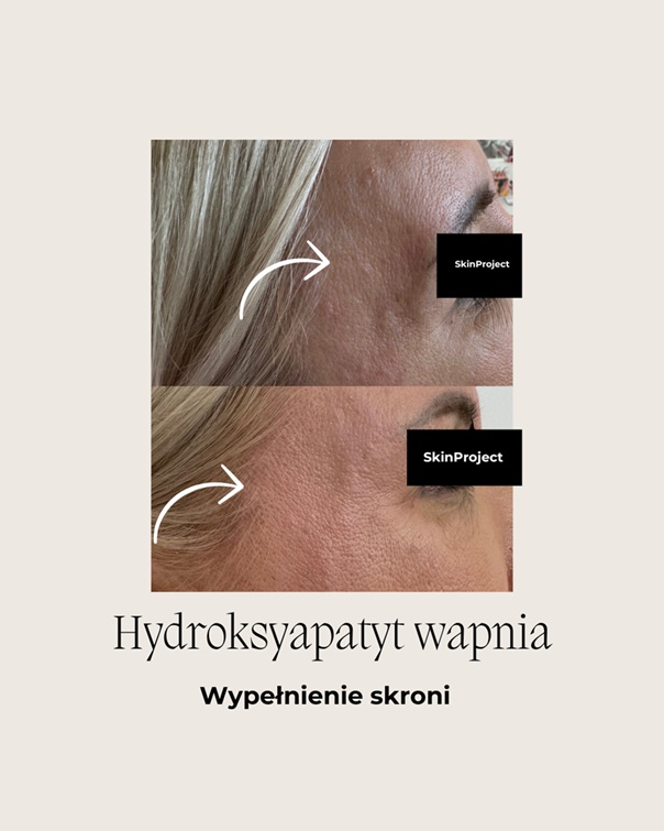 Hydroksyapatyt wapnia przed i po 6